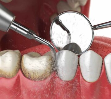 Diş taşı temizliği nasıl yapılır