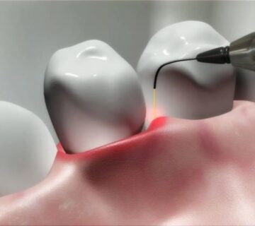 diş eti çekilmesine ne iyi gelir