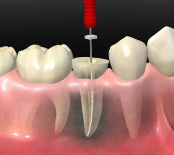 diş kanal tedavisi