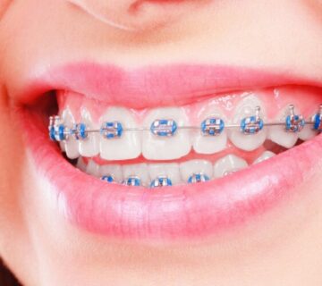 diş teli nasıl takılır