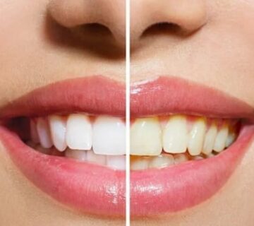 diş-sarılığı-neden-olur