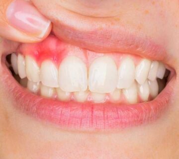 diş-eti-hastalığı-nedir